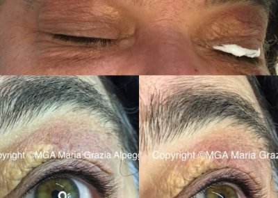 Infraccigliare superiore