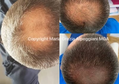 Tricopigmentazione riempimento uomo-min