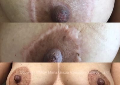 a copertura cicatrici areola e capezzolo 1