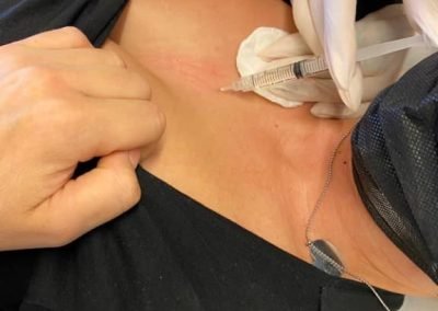 acido ialuronico mesoterapia