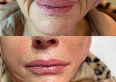 acido ialuronico ringiovanimento