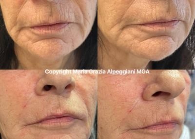 acido ialuronico ringiovanimento viso