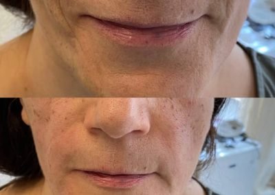 acido ialuronico viso