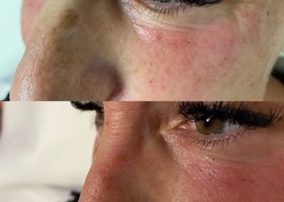 biorivitalizzazione occhi