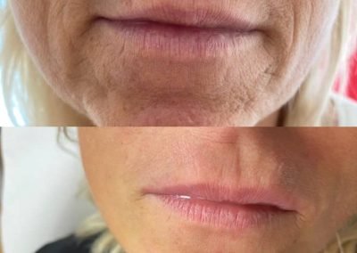 biorivitalizzazione viso