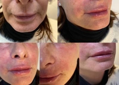 biorivitalizzazione vitamine acido ialuronico