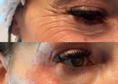 blefaro ed eliminazione rughe