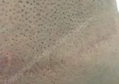 cicatrice nucale da FUT dopo