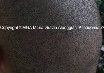 cicatrici da autotrapianto FUE dopo