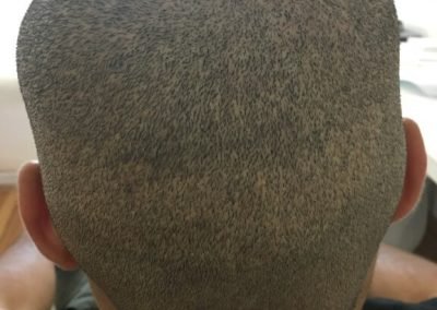 cicatrici da autotrapianto FUE prima