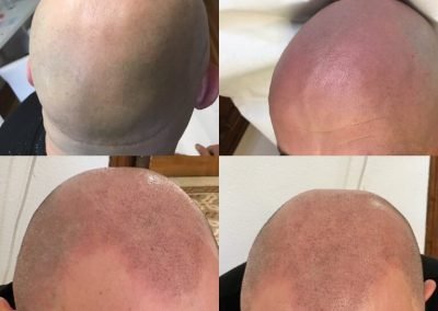 copertura cicatrice fut ed effetto rasato cuoio capelluto