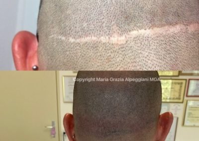 copertura cicatrice nucale da autotrapianto