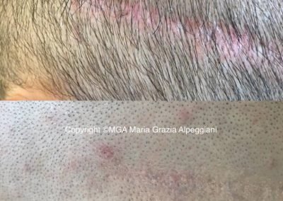 copertura cicatrice smile FUT