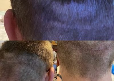 copertura cicatrici nucali da autotrapianto uomo