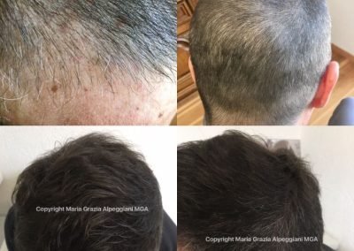 copertura ed esito prima e dopo infoltimento cuoio capelluto