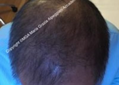 copertura su capello lungo uomo dopo