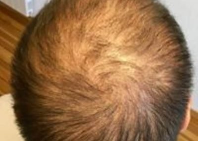 copertura su capello lungo uomo prima