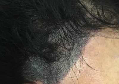 copertura tempie dopo