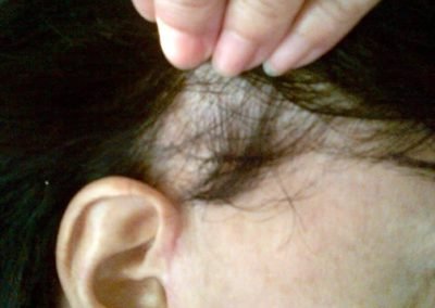 copertura tempie prima