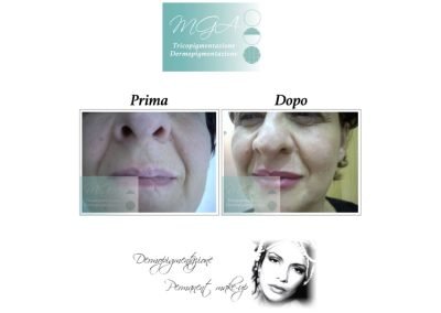 copertura cicatrice labiale e definizione