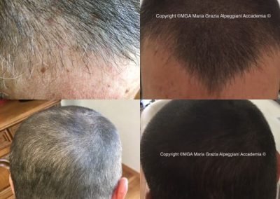 coprtura tempie e densità