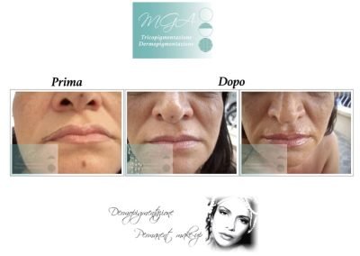 correzione labbro nero