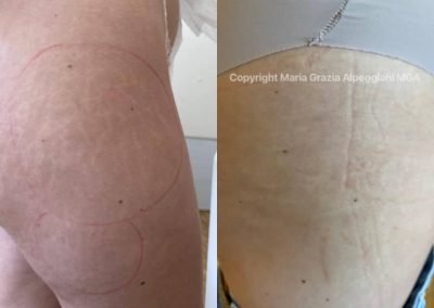 dermopigm copertura smagliature