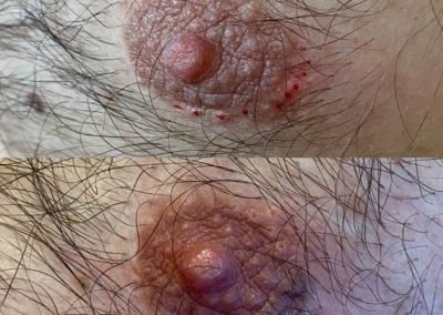 dermopigmentazione seno maschile