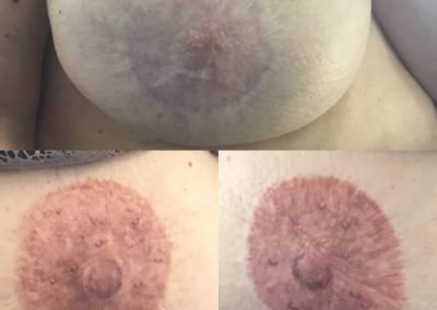 dermopigmentazione seno ricostruzione totale