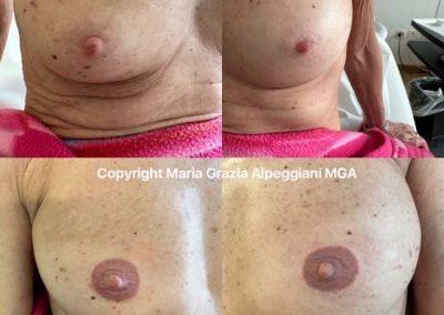 dermopigmentazione seno ricostruzione totale areola