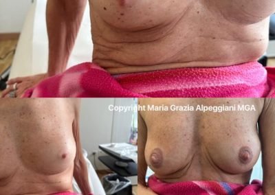 dermopigmentazione seno subito dopo trattamento
