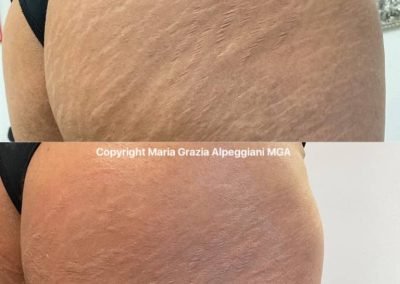 dermopigmentazione smagliature