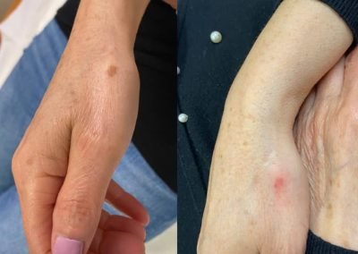 eliminazione macchie mano