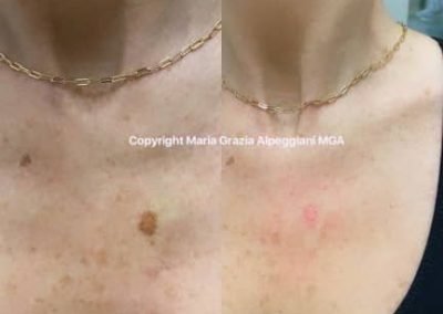 eliminazione macchie petto plasma