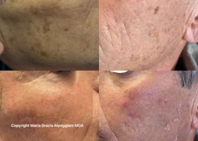 eliminazione macchie uomo plasma pen