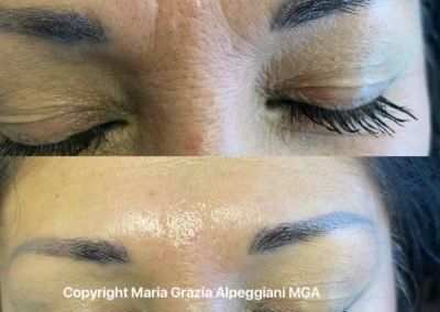 fili di seta bioriassorbibili fronte