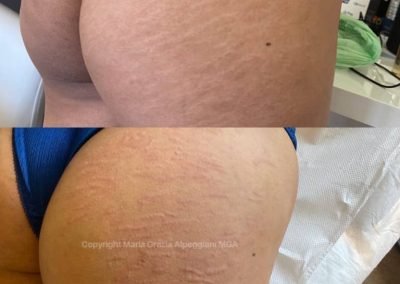glutei smagliature copertura dermopigmentazione