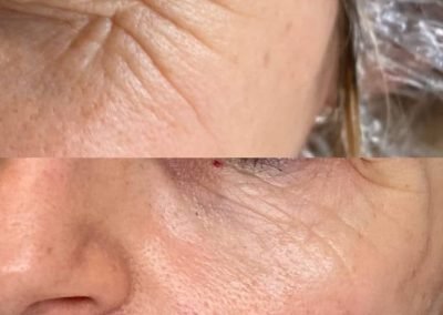 idratazione acido ialuronico