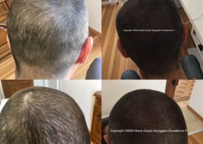 infoltimento cuoio capelluto