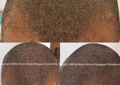 infoltimento tempie tricopigmentazione