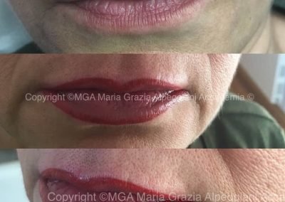 ingrandimento labbro