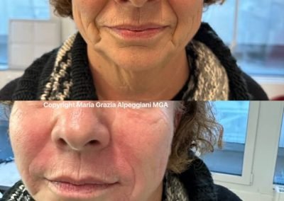 iniezioni acido ialuronico viso