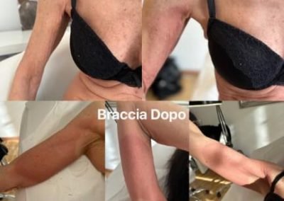 lifting braccio destro