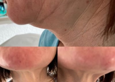 lifting collo non chirurgico