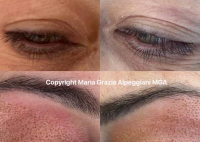 lifting non chir occhi palpebre