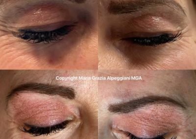 lifting non chir palpebr-min