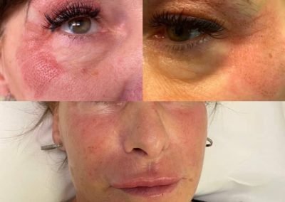 lifting non chirurgico occhi-min