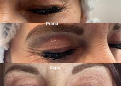 lifting non chirurgico palpebre-min