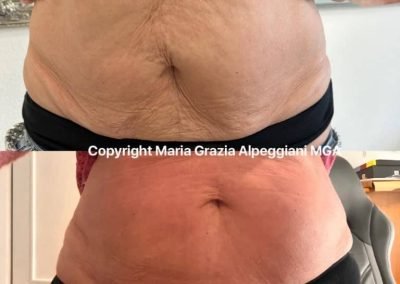 lifting pancia e tonificazione cellulite dimagrimento-min