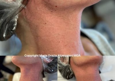 lifting sottomento e collo b-min